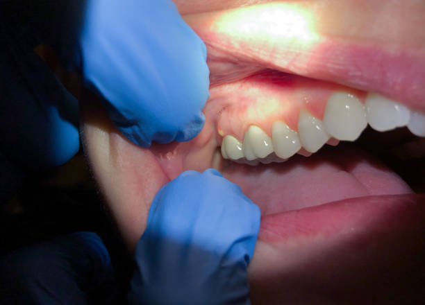Best Emergency Wisdom Teeth Removal in USA